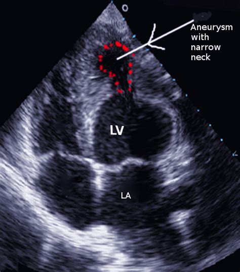 lv aneurysm